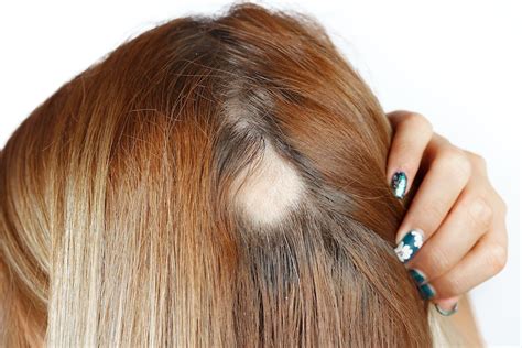 alopecia feminina causas